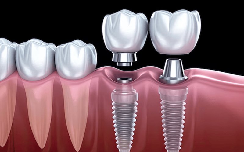 Dental Implants