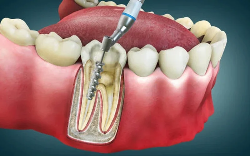 Root Canal Treatment
