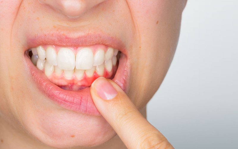 Advanced Gum Treatment