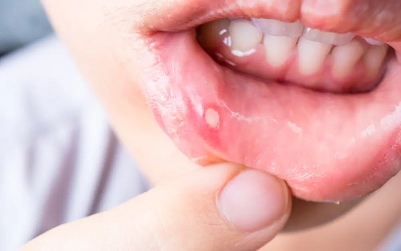 Mouthulcers