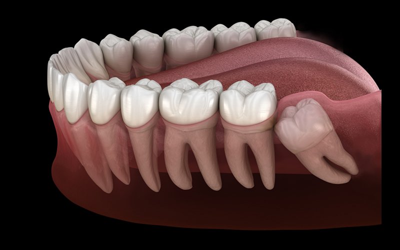 Wisdom Teeth Removal
